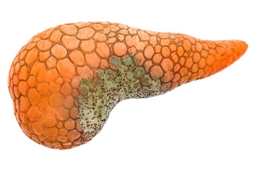 Pancreatic disease concept, 3D rendering - obrazy, fototapety, plakaty