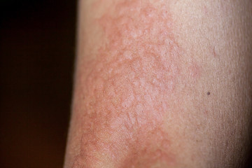 Urticaria on skin