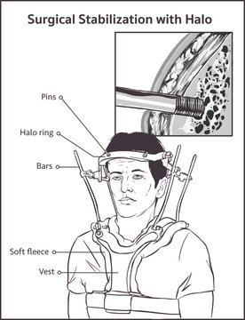 Lateral View Of Adult Male In Halo Vest Traction