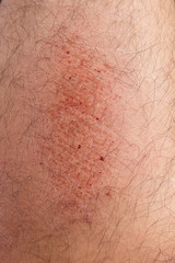 closeup of abrasion