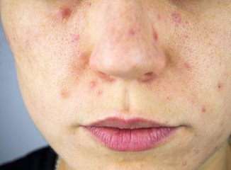 Young woman with acne, melasma, dark spots, freckles on his face. Dermatology, problem skin care and health concept image. Part of body, selective focus.