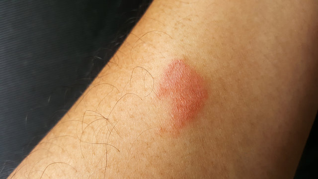 close-up centipede bite, poisonous hurt arm