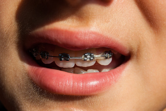Fixed device with elastic on the teeth of a teenager