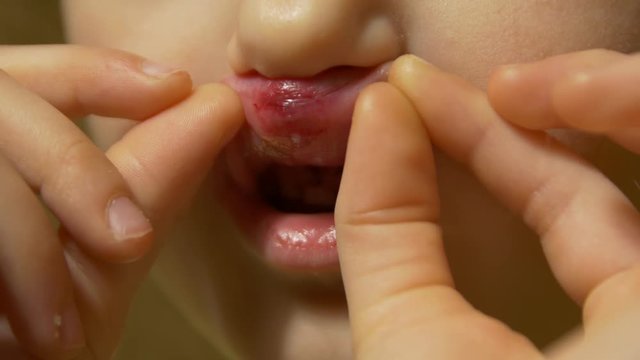 The Broken Mouth Lips