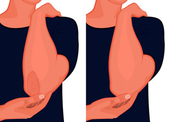 Vector illustration. Psoriasis on the elbow skin before and after treatment. For advertising and medical publications
