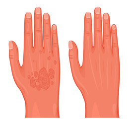 Vector illustration. Psoriasis on the skin of the hands before and after treatment. For advertising and medical publications