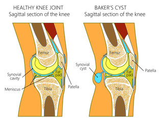 Vector illustration of a healthy human knee joint and unhealthy knee with Baker's cyst. Anatomy of human knee, sagittal section of the knee. for advertising and medical publications