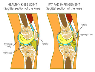 Vector illustration of a healthy human knee joint and unhealthy knee with Hoffa's fat pad impingement syndrome. Knee anatomy, sagittal section. For advertising and medical publications