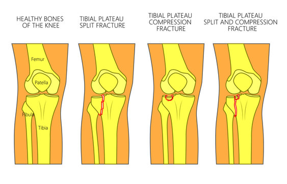 Vector illustration of a healthy bones of human knee and a knee with tibial plateau split, compression or depression fractures. Front view of the knee. For advertising, medical publications