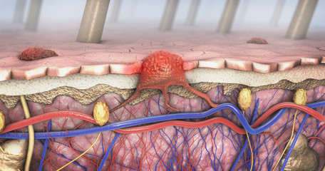 3d illustration of a cross-section of a diseased skin with melanoma that enters the bloodstream and lymphatic tract - obrazy, fototapety, plakaty
