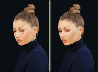 Post-Acne Marks /Treating Acne Scars.Acne Scar Removal