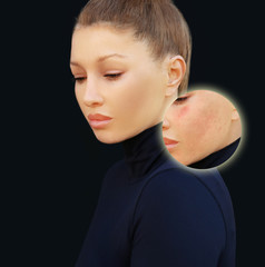 Post-Acne Marks /Treating Acne Scars.Acne Scar Removal