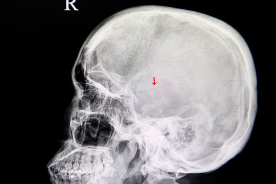 xray image of a patient with linear fracture skull from traumatic injury.