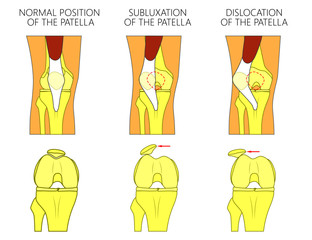 Vector illustration of a healthy human knee joint and unhealthy knees with problem. Subluxation and dislocation of the patella or kneecap. Anatomy of human knee joint, front view of straight and bent 