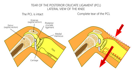 Vector illustration anatomy of a knee joint with healthy and torn posterior cruciate ligament. Side or lateral view of flexed knee with sagittal section of femur bone. For medical publications