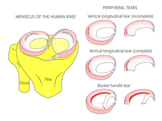Vector illustration. Anatomy of a meniscus in the healthy human knee joint. Peripheral meniscal tears with cross section of the menisci. For advertising, medical publications