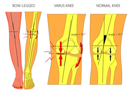 Vector illustration diagram. Shapes of human legs. Normal and curved legs. Knock knees. Bowed legs. Genu valgum and genu varum.  For advertising, medical publications