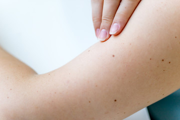 a birthmark or a mole on a woman skin