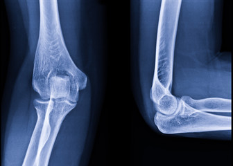 Radiography of Right elbow AP and Lateral position. Medical concept.