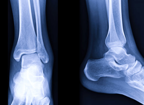 Radiographic image or x-ray image of Left ankle joint.