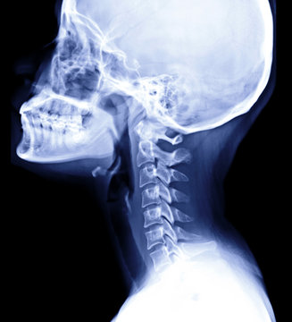 x-ray image of cervical spine or neck Lateral view or side view isolated on Black Background.