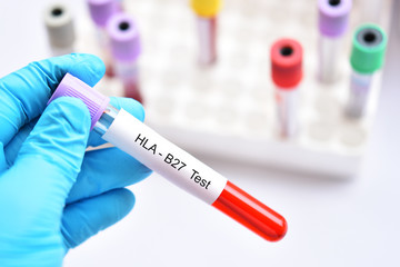 Blood sample tube for HLA-B27 test
