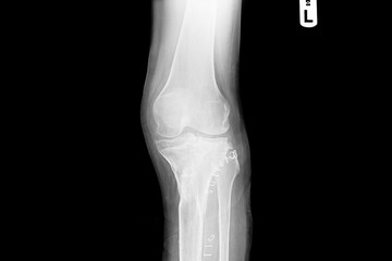 internal of left leg fixed with plate and screws.