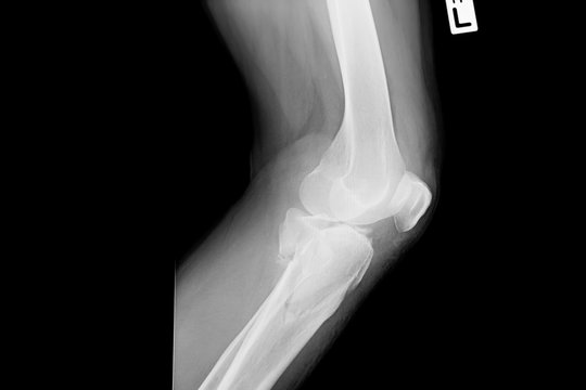 film X-ray image left Knee. X-ray of left knee of 51-year-old asian man from side.