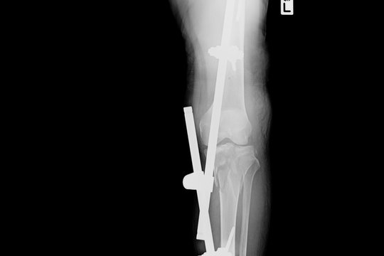 Show fracture tibia and fibula left lateral. X-ray image of fracture leg with implant external fixation.