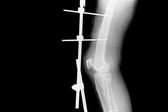 Show fracture tibia and fibula left lateral. X-ray image of fracture leg with implant external fixation.