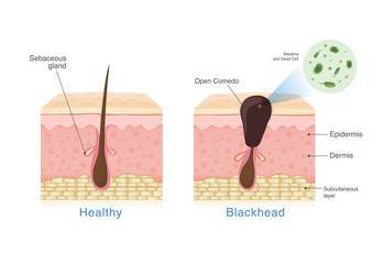 Bacteria in blackhead with human skin layer structure and Healthy skin. Illustration about dermatology diagram .