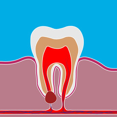 Flat style of dental disease with pain and inflammation. Medical illustration of tooth root inflammation, tooth root cyst, pulpitis.