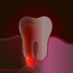 X-ray effect. The transition from a real tooth to a linear x-ray effect with a point of pain and inflammation. Medical illustration of tooth root inflammation, tooth root cyst, pulpitis.