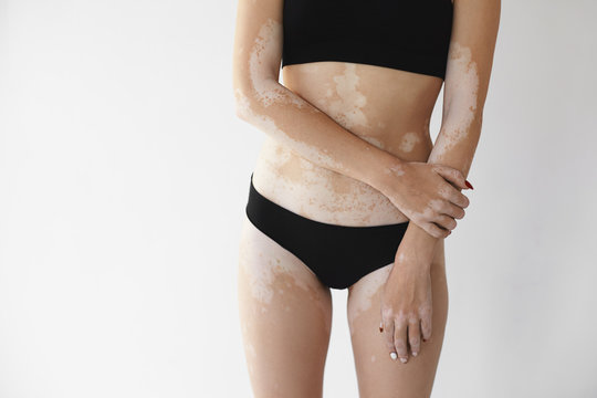 Cropped image of young woman with skin auto immune condition disorder posing indoors. Studio shot of unrecognizable female with pale vitiligo patches all over her body, dressed in black underwear