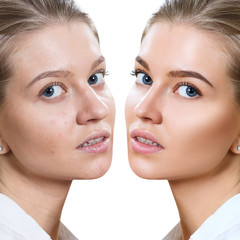 Young woman before and after skin treatment and makeup.