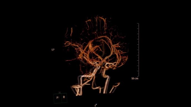 CT angiography of the brain or cta brain,  3D Rendering image .  medical concept.