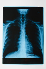 X-ray of a thorax, close-up. X-Ray film of human skeletal system