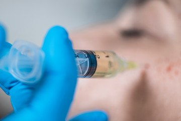 PRP Face Injecting Treatment.  Cosmetic Anti-Aging Platelet Rich Plasma Treatment
