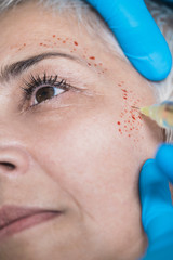 PRP Face Injecting Treatment.  Cosmetic Anti-Aging Platelet Rich Plasma Treatment