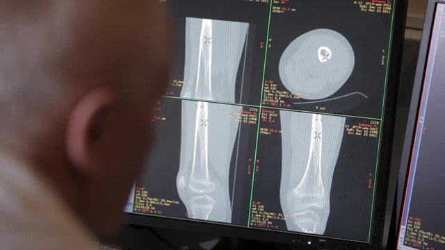 Pictures of the bone scan on the monitor.