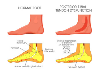 Vector illustration of  healthy human foot and a medial ankle injury. Posterior tibial tendon dysfunction