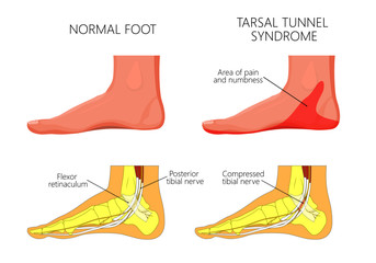 Vector illustration of  healthy human foot and a medial ankle injury. Tarsal tunnel syndrome