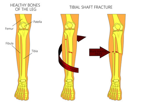Vector illustration of a healthy bones of human leg and a leg with tibial shaft fracture. Twisting, blunt trauma injury. Front view of the foot with knee. For advertising, medical publications
