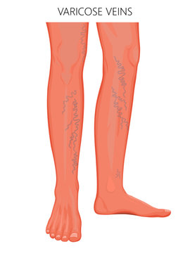 Vector illustration of a human leg with varicose veins injury. For advertising of medical procedures of varicose treatment and medical publications. Medial,front view of the leg