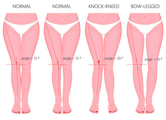 Vector Illustration. Shapes of the  legs. Normal and curved legs. Knock knees. Bowed legs. Genu valgum and genu varum.  For advertising, medical (health care),  publication.