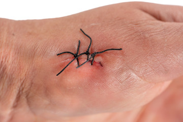 Caucasian left hand with 3 stitches, macro view