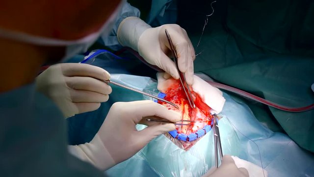 close-up of the operation of trepanning surgeon opens access to the bones of the skull cutting the soft tissue of the patient