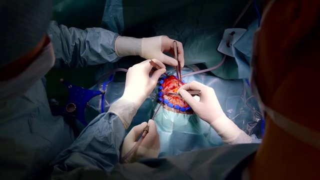 close-up skull trepanation surgery to remove a tumor in the temporal lobe the surgeon opens access to the skull bone by cutting the patient's soft tissue
