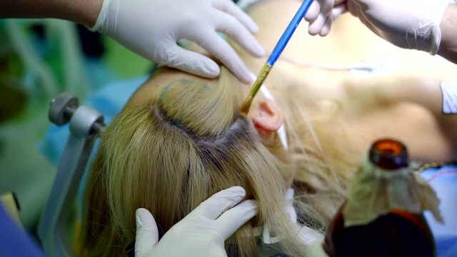 close-up preparation of the patient for surgery craniotomy in the temporal lobe. fixing hair with wet collodium
