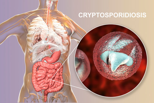 Cryptosporidiosis, a diarrheal disease caused by Cryptosporidium parvum protozoan. 3D illustration showing release of parasite sporozoites from oocyst inside small intestine